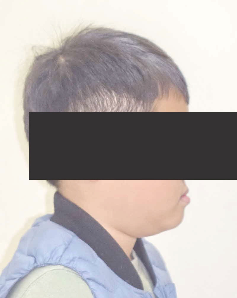 반대교합 치아교정