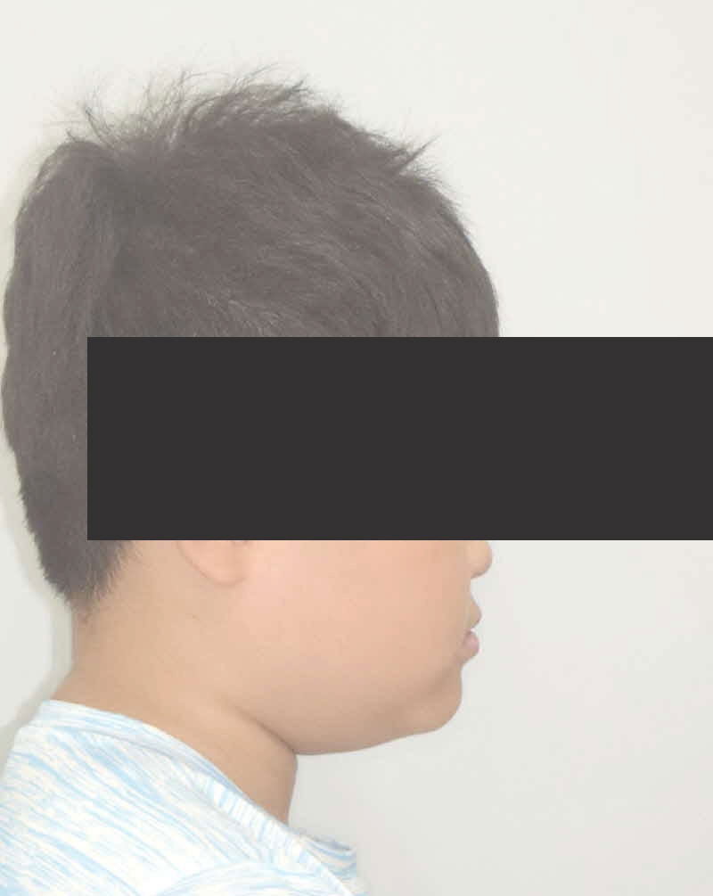 반대교합 치아교정